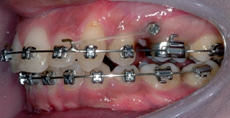 Mini Screws Orthodontic Treatment